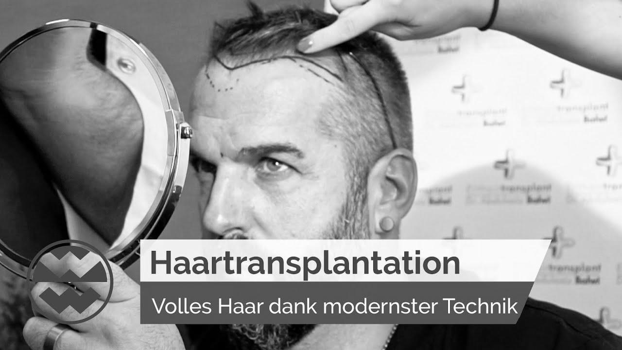 Hair Transplant: State-of-the-Art Approach for Full Hair – Life Goes On |  world of wonders