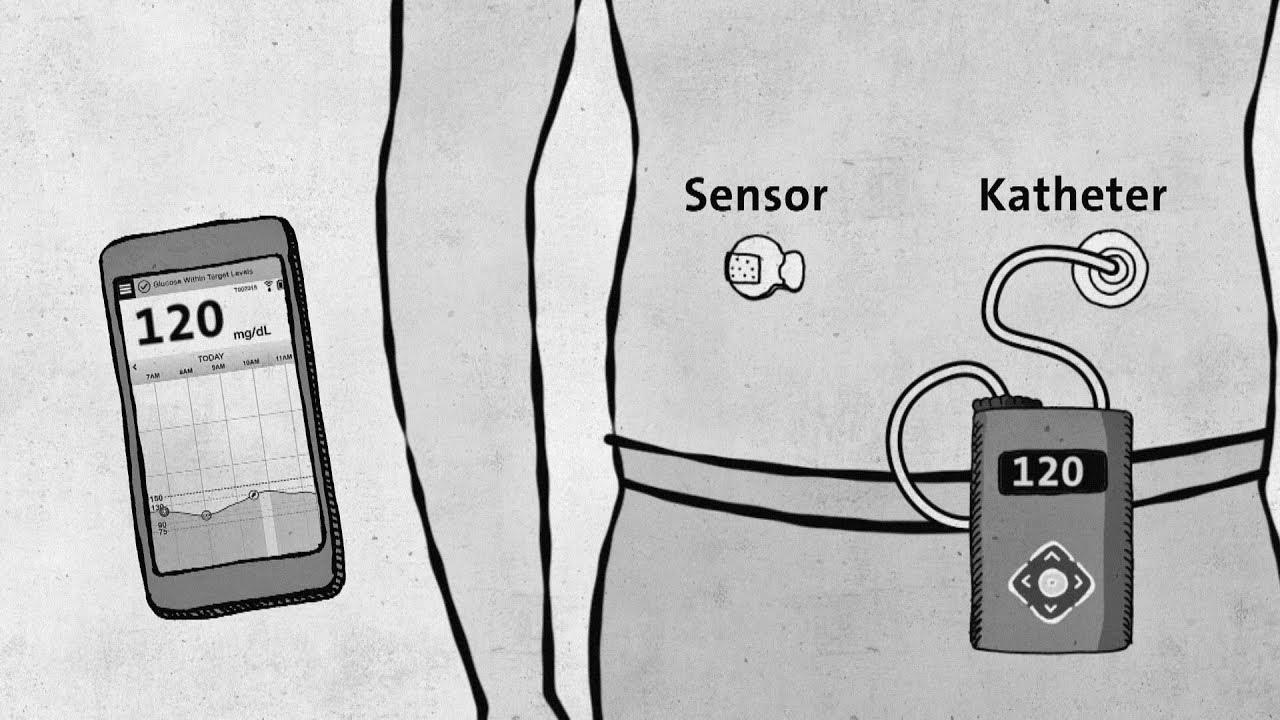 Sort 1 diabetes – trendy technology without approval – good to know